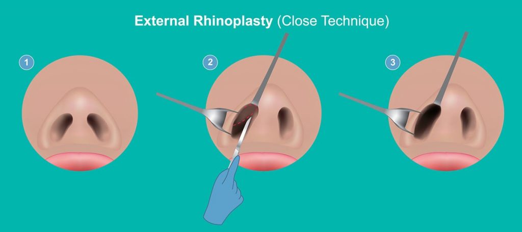 closed rinoplasti